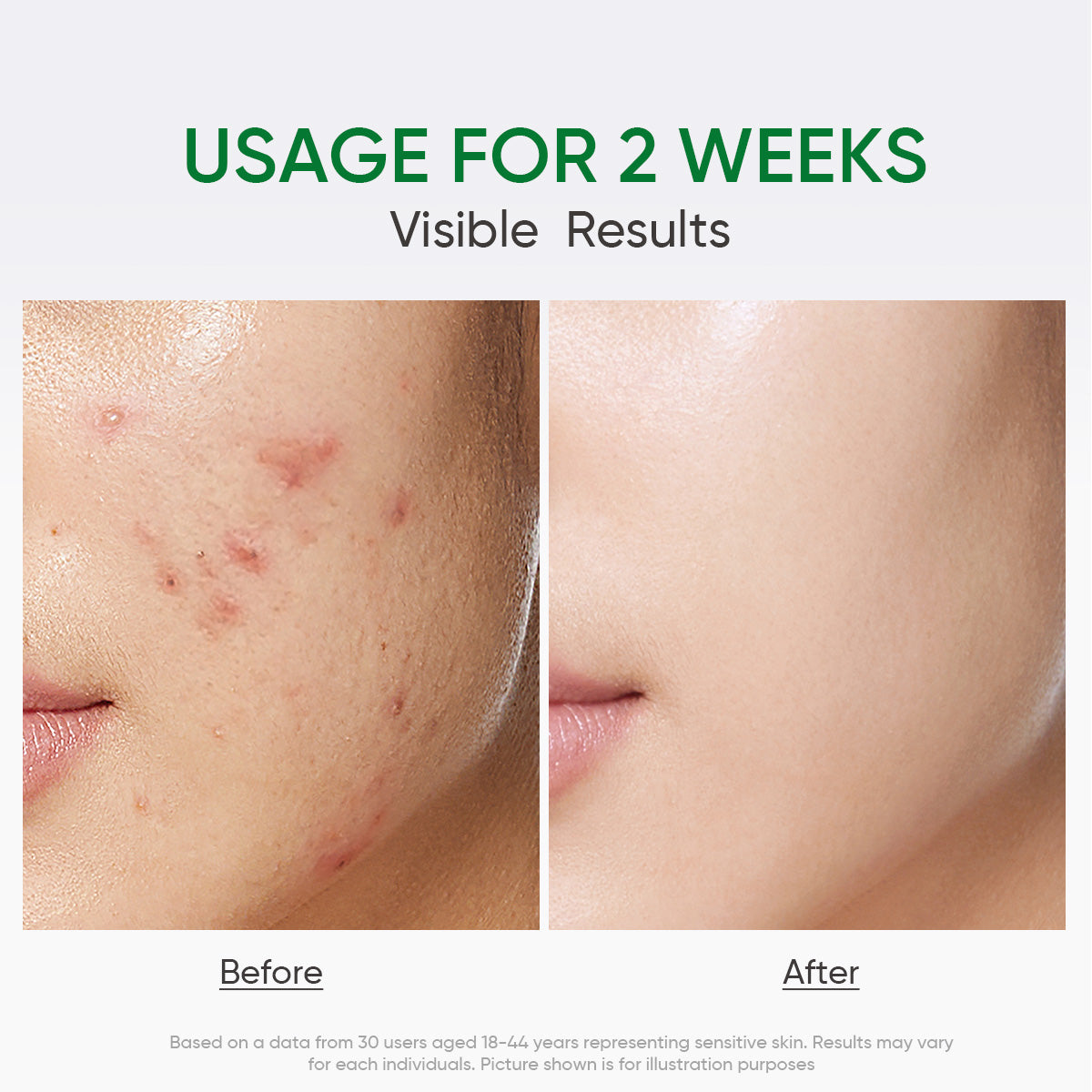 Salicylic Acid Acne Gel Cleanser