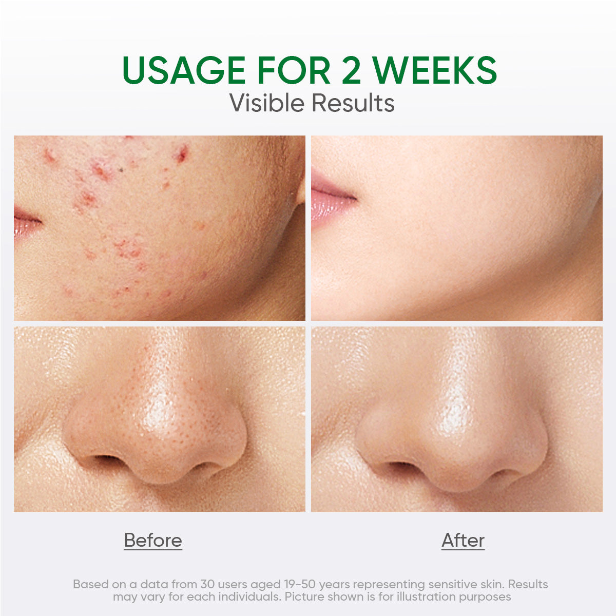 Salicylic Acid Acne Toner