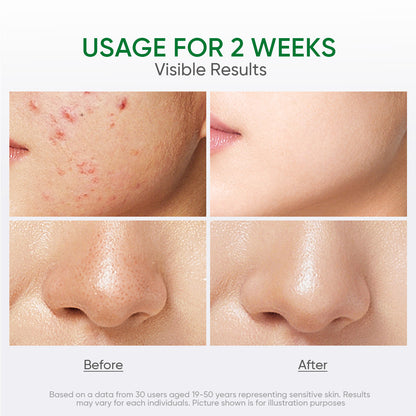 Salicylic Acid Acne Toner