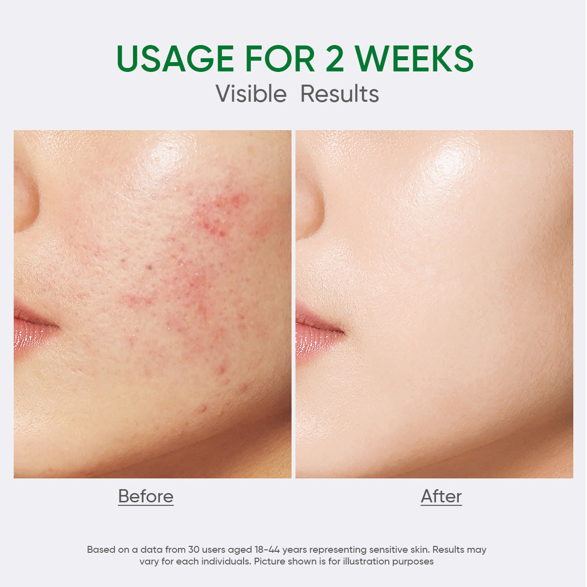 Salicylic Acid Acne Moisturizer
