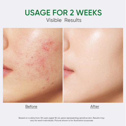 Salicylic Acid Acne Moisturizer
