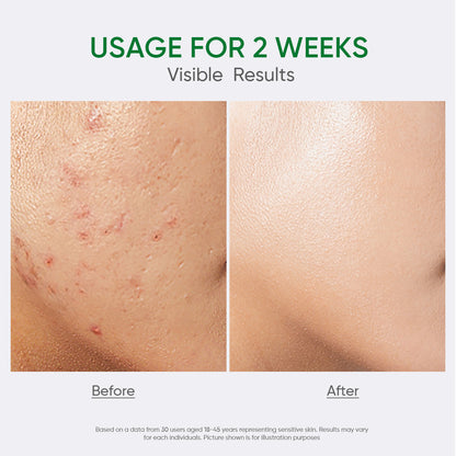 2% Salicylic Acid Acne Serum